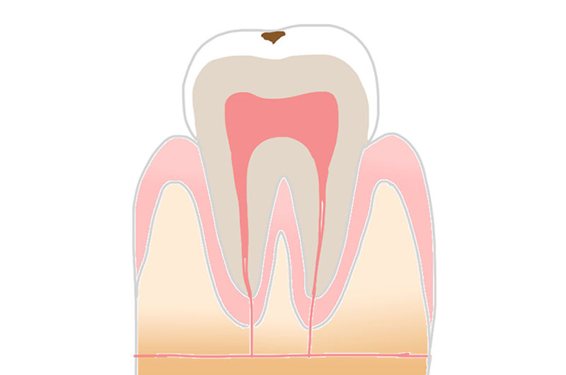 エナメル質の虫歯（C1）